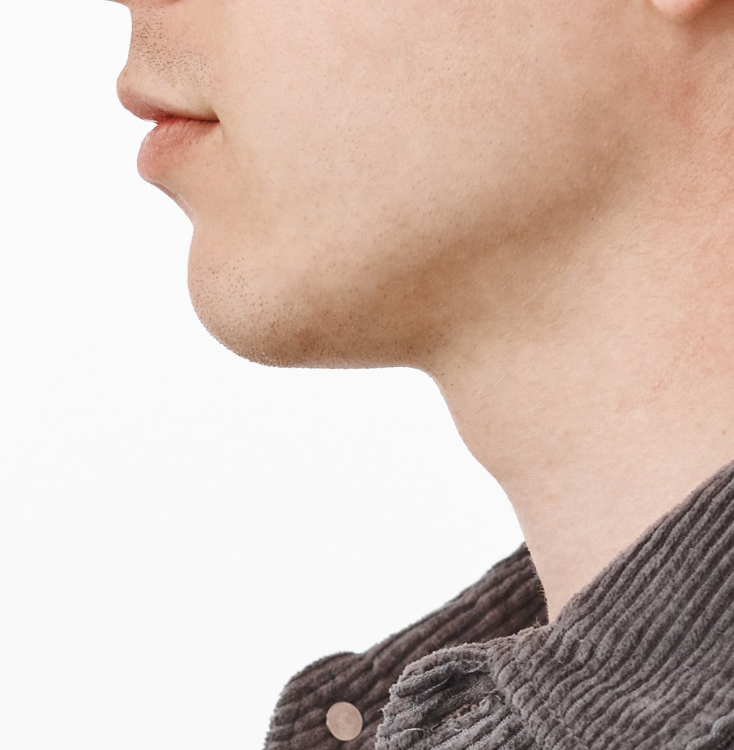 Side profile of a small chin that slopes back toward the neck