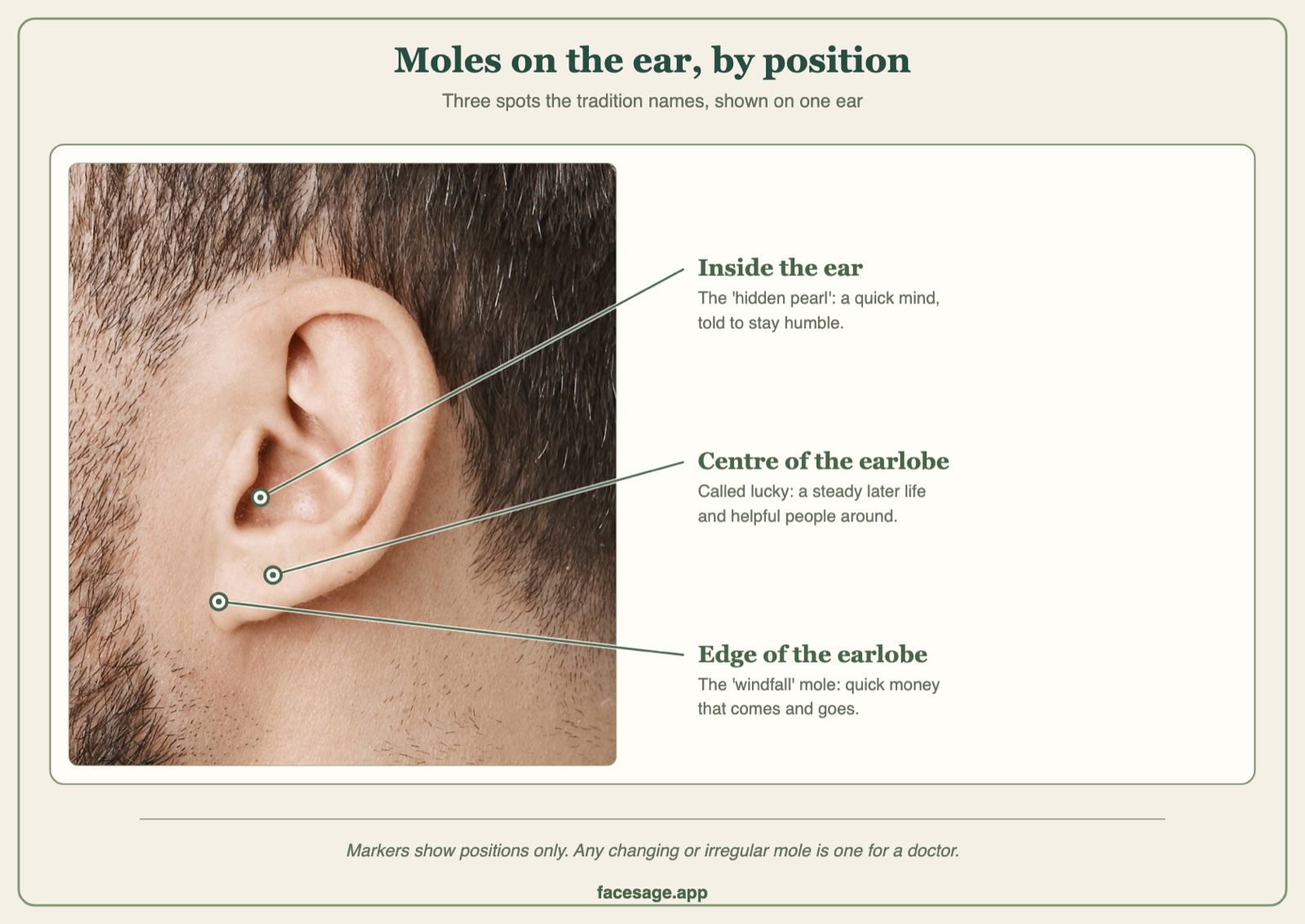 Real ear close-up with three marked positions for ear moles