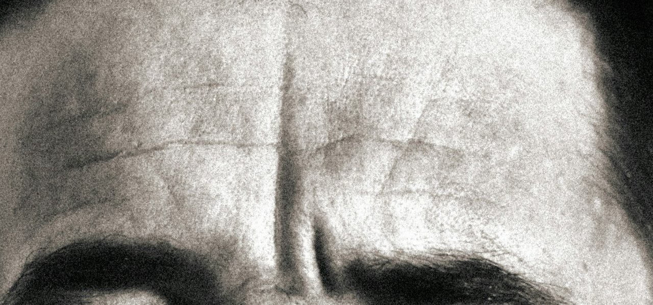 Close-up of a forehead with one deep vertical line in the centre above the eyebrows
