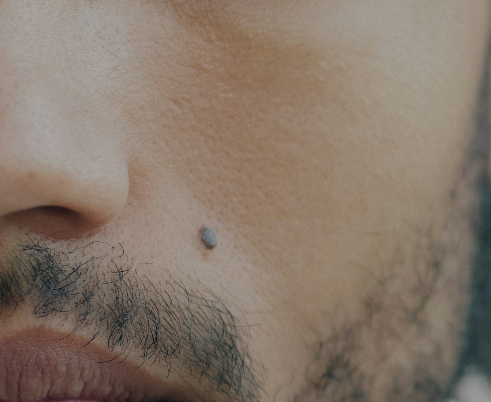 Close-up of a small dark mole on a man's cheek