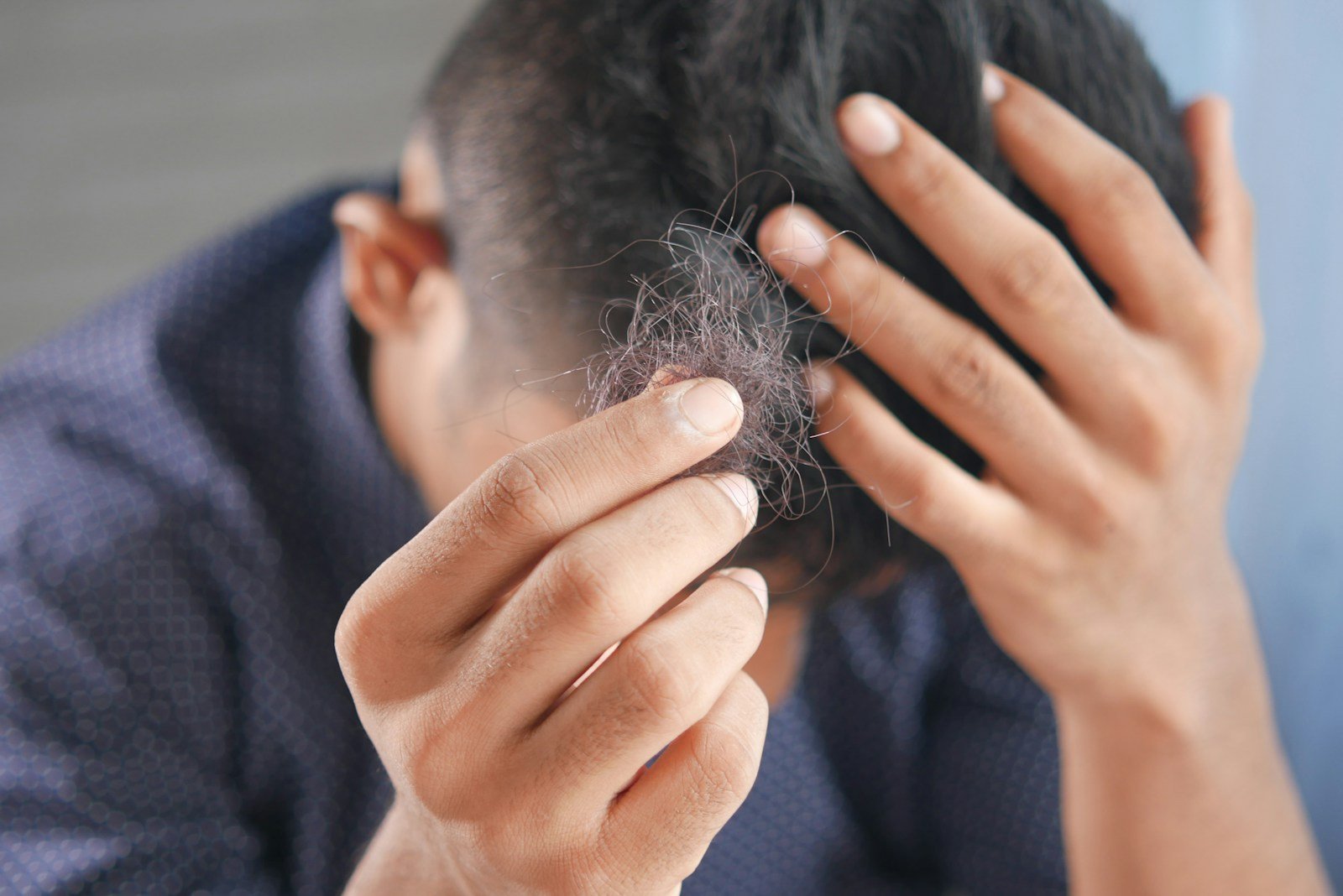 Man checking his thinning hairline, holding loose hairs in his fingers