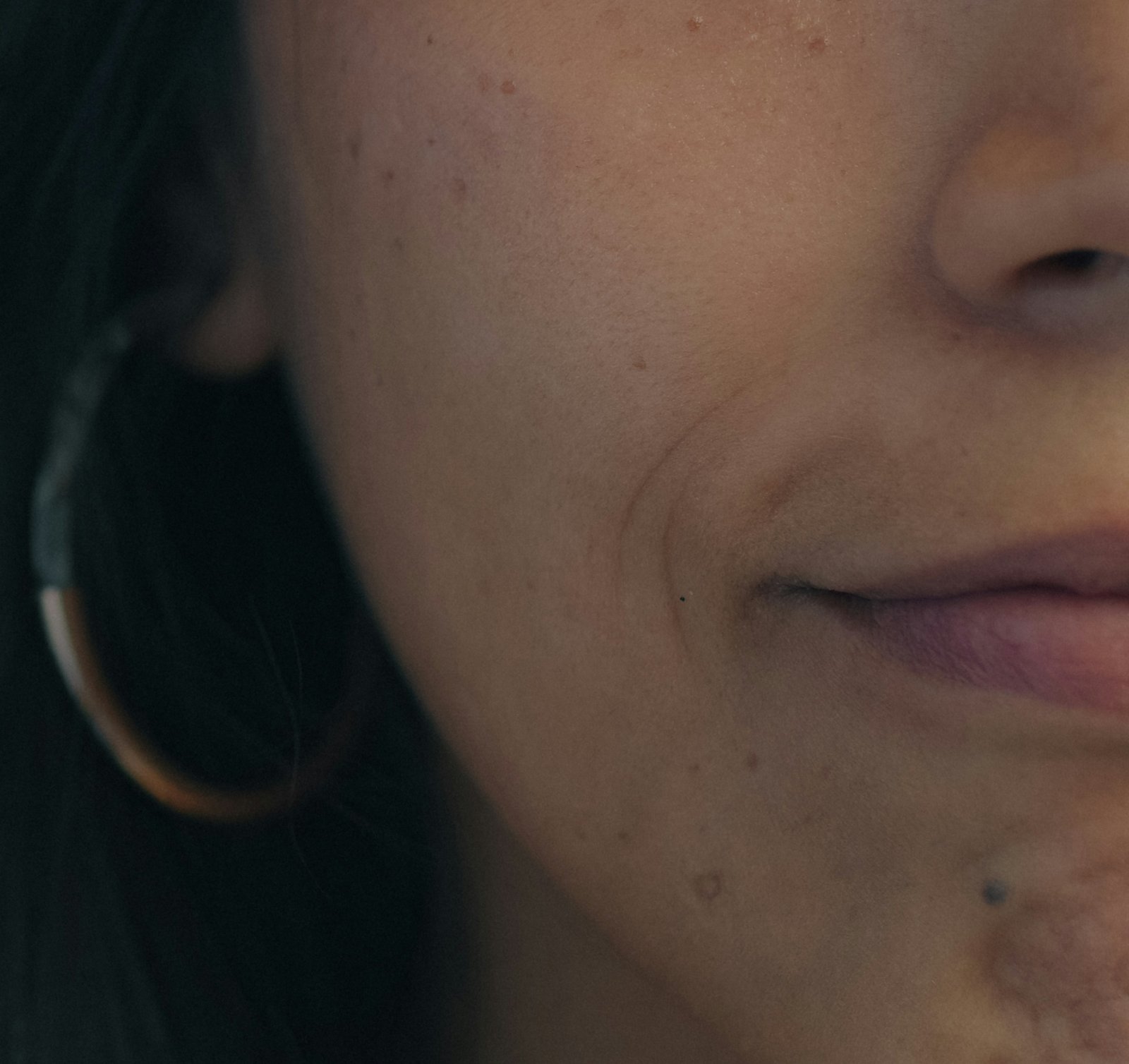 A cheek and jawline with small moles