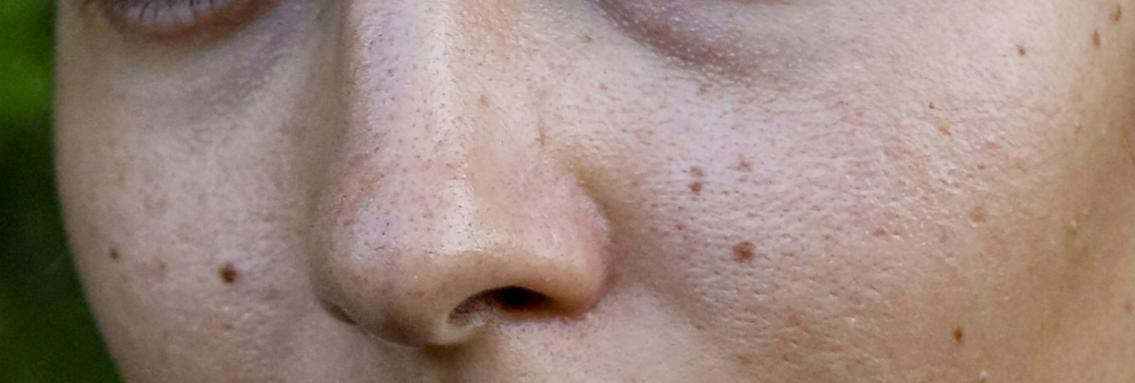 Cheeks with several small dark moles beside the nose