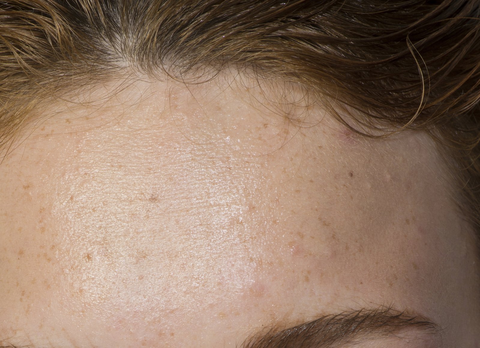 Close-up of a forehead below the hairline
