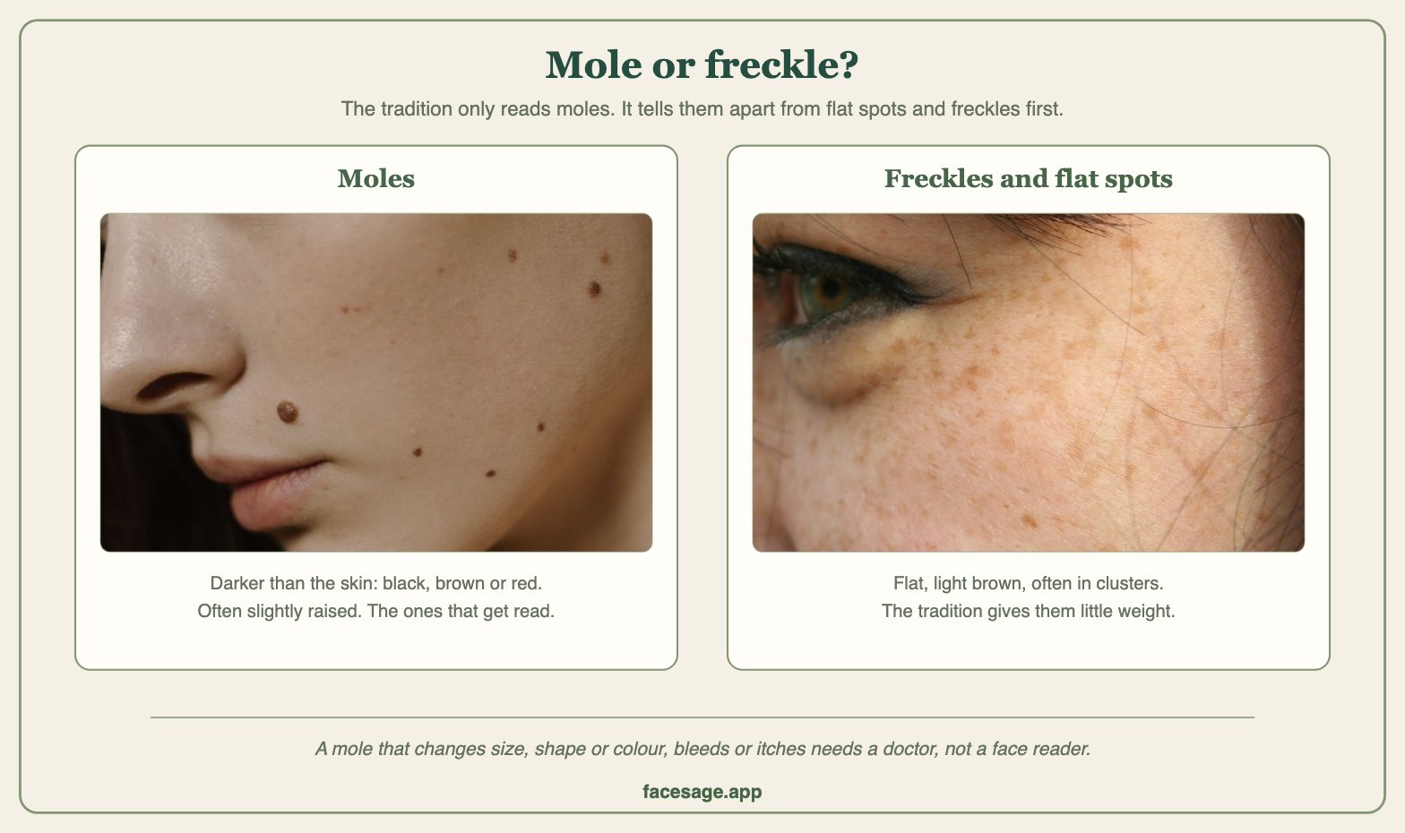 Two real skin close-ups comparing dark moles with flat freckles