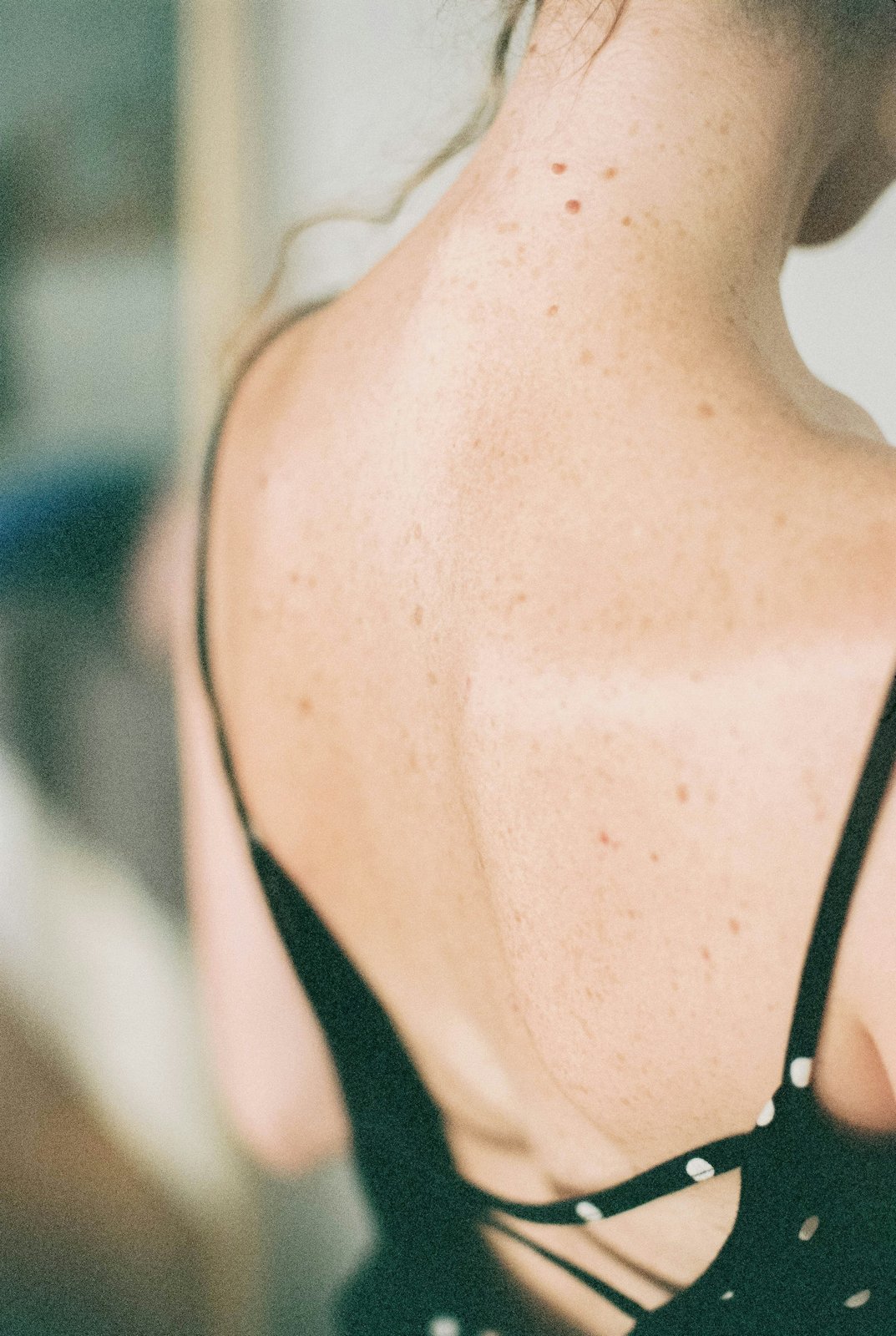 Upper back of a woman seen from behind, with small moles