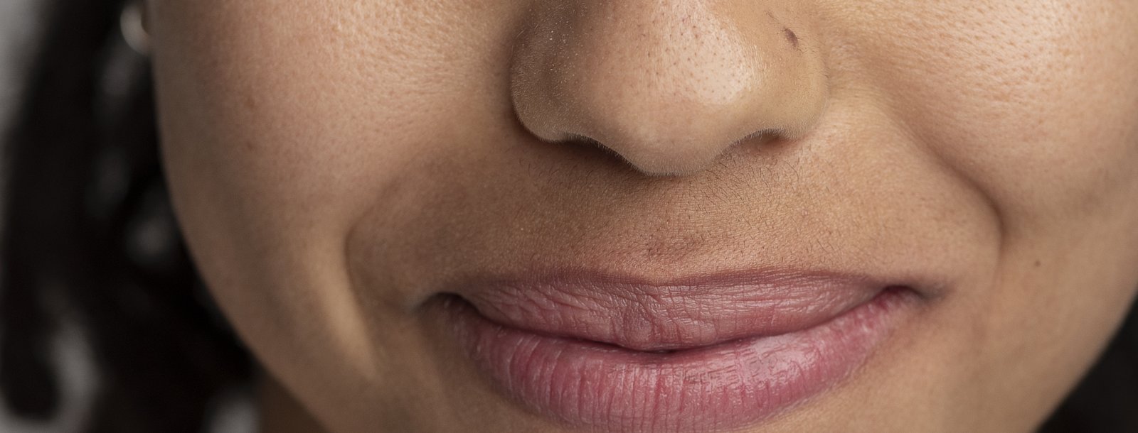 A smile showing the nasolabial folds