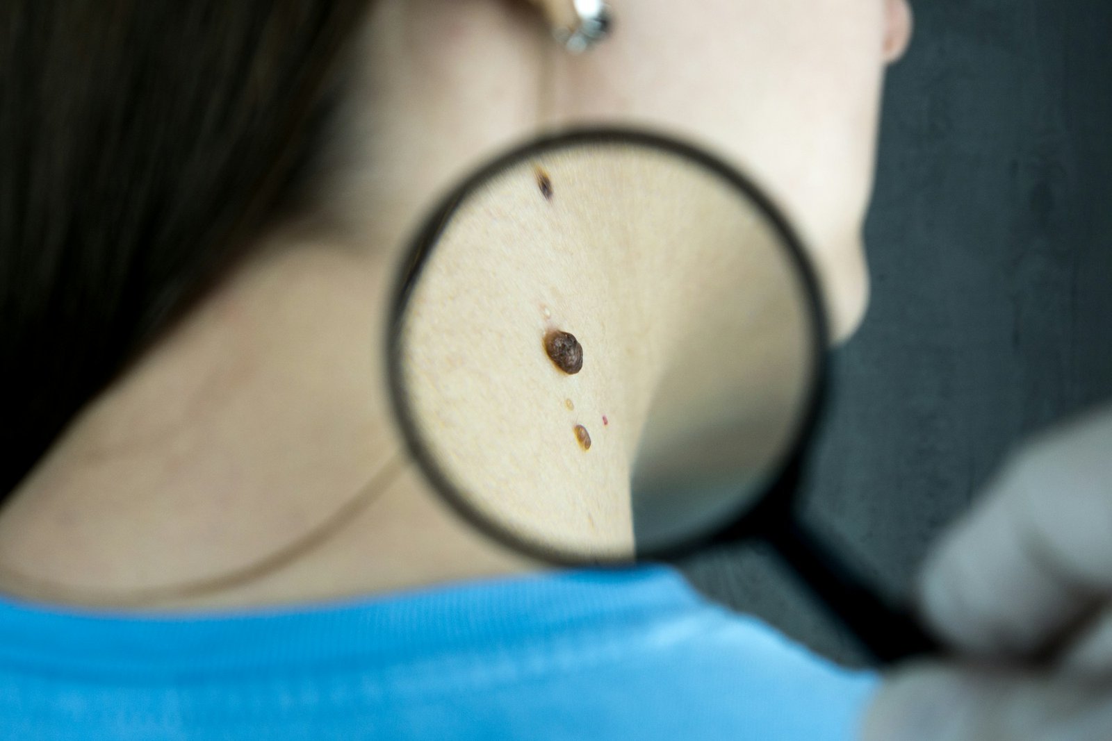 Magnifying glass over moles on a neck during a skin check