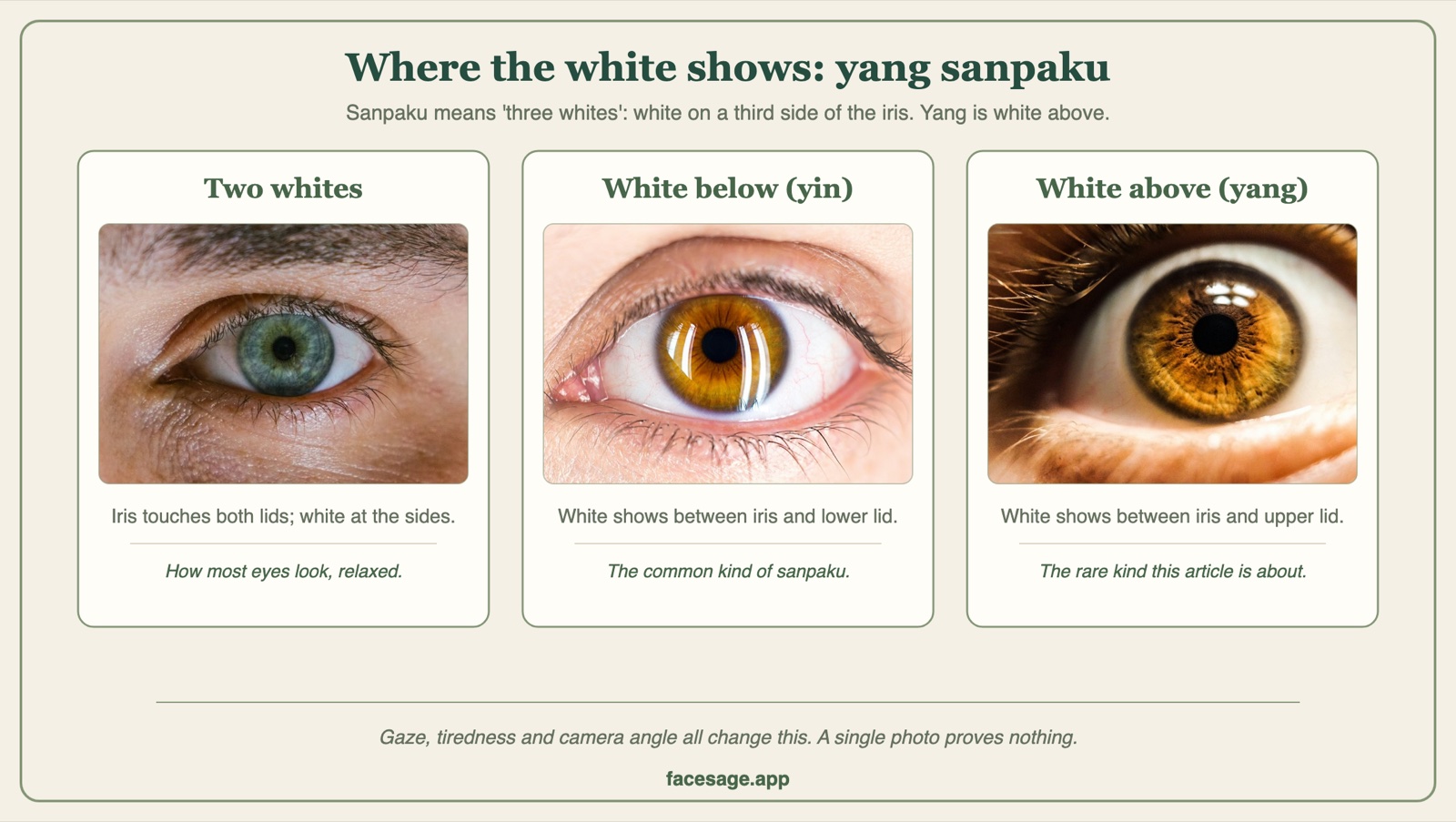 Three eye close-ups comparing a typical eye, white showing below the iris, and white showing above the iris